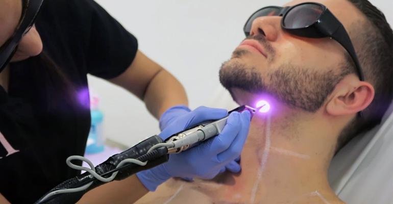 Laser Hair Removal Treatment